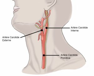 Dr Andrzejewski - Sténose carotidienne