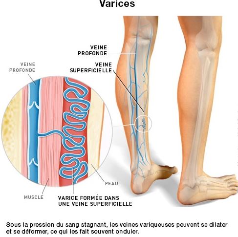 Dr Andrzejewski - Varices