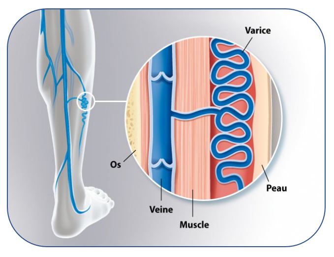 Dr Andrzejewski - Insuffisance veineuse